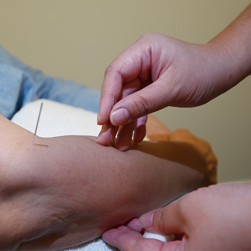 Healing-Moments-massage-and-acupuncture-acupuncture-process acupuncture process