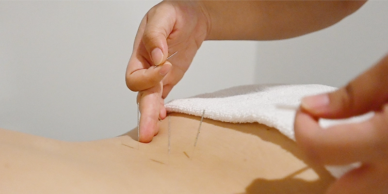 Healing-Moments-Massage and Acupuncture-gift-voucher-acupuncture-v2 acupuncture