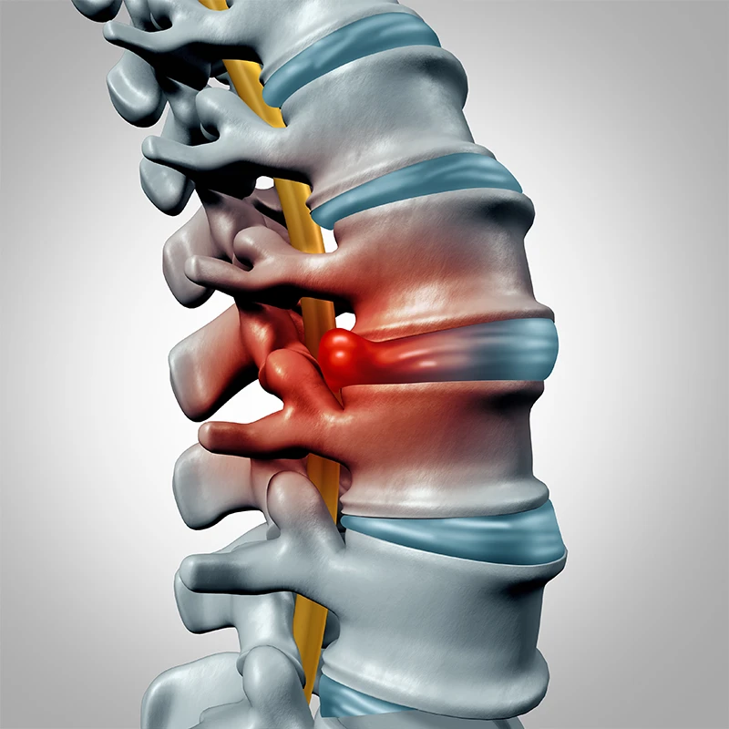 Herniated disc
